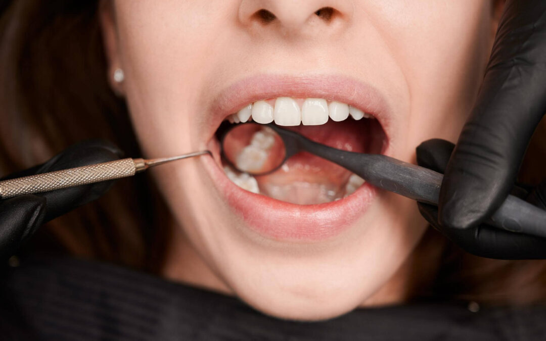 Understanding Periodontal Pockets: What They Mean for Your Oral Health
