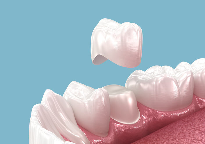 Dental Crowns at Anthem Dentistry