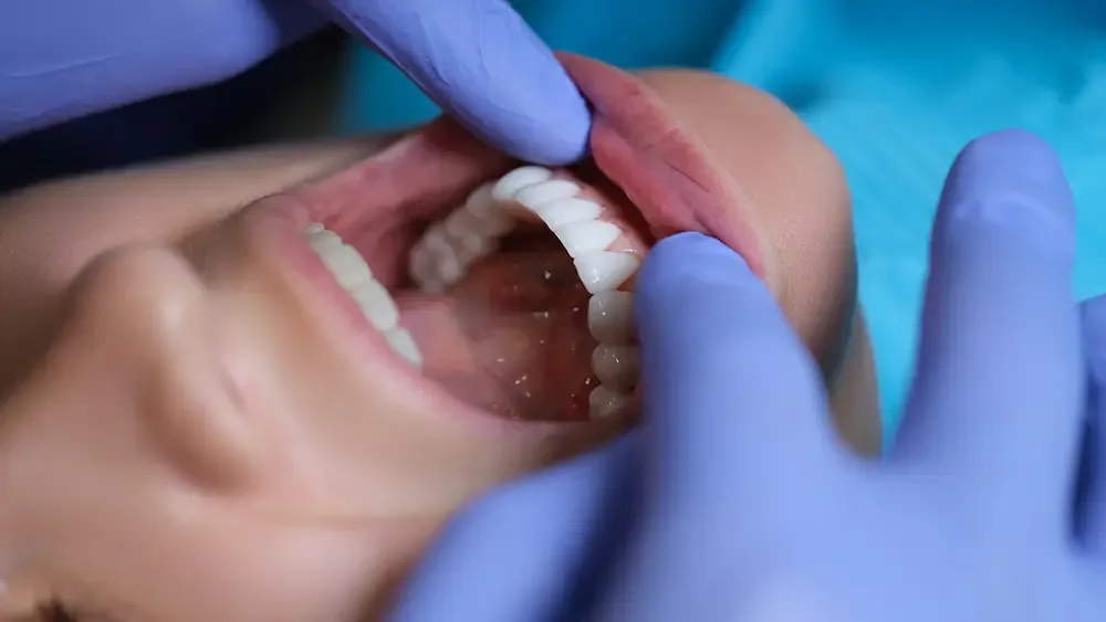 Porcelain vs composite veneers comparison
