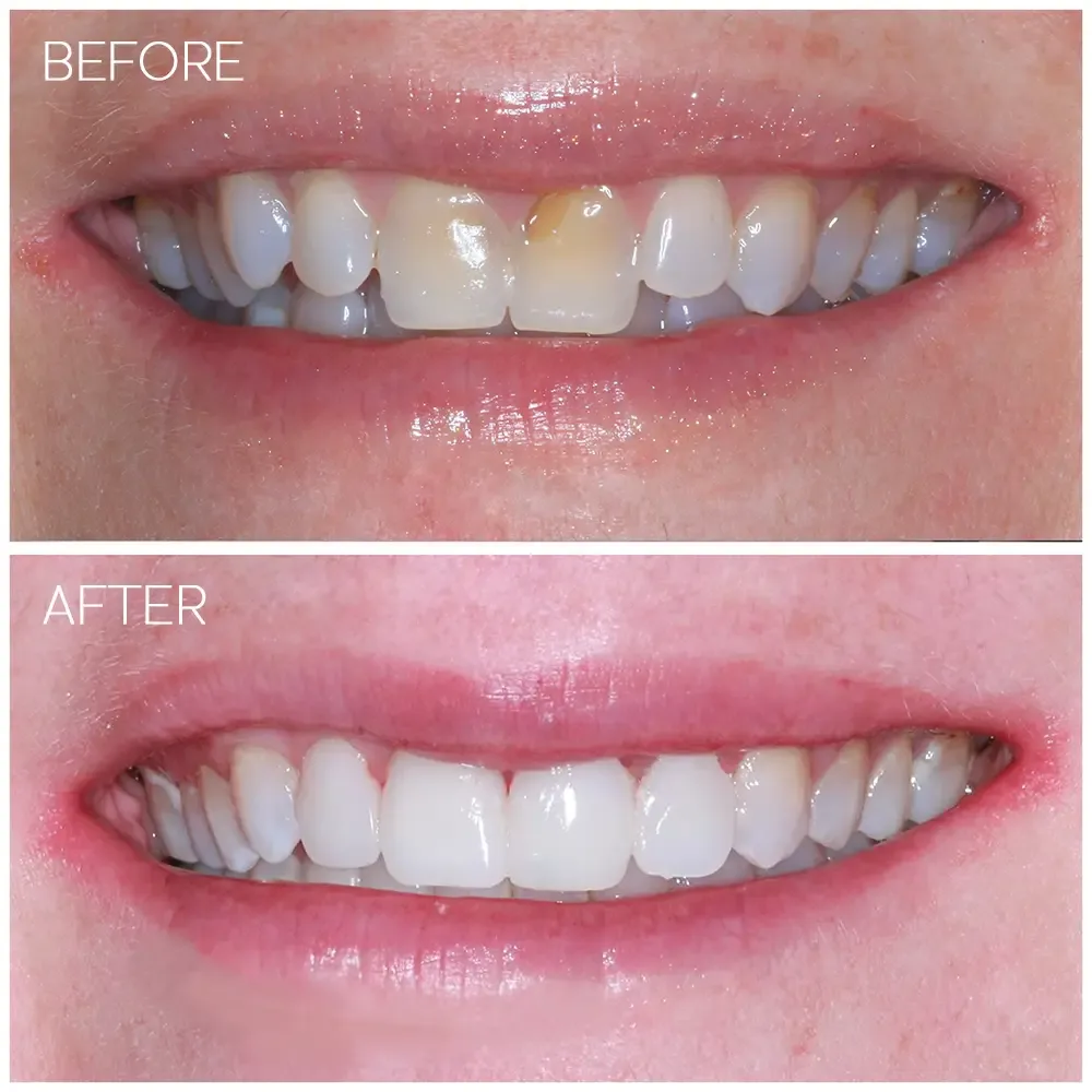 Veneer smile transformation before and after