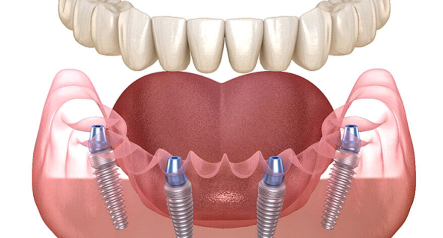 Implant denture diagram